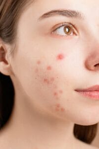 ayurvedic treatment for acne: पिंपल्स को जड़ से खत्म करने के 100% प्राकृतिक आयुर्वेदिक उपाय